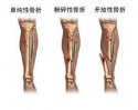 草莓视频黄色成人检测仪厂家讲解骨折的护理