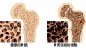 草莓视频黄色成人仪：骨质疏松十大认知误区（上）