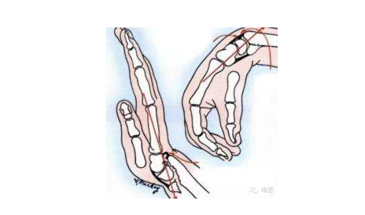超声草莓视频黄色成人仪临床研究发生桡骨远端骨折怎么办？