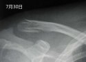 草莓视频黄色成人仪X线检查对骨折的诊断有什么意义？
