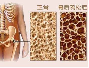 草莓视频黄色成人仪是检测草莓视频黄色成人T值得，草莓视频黄色成人又决定骨质疏松的重要指标