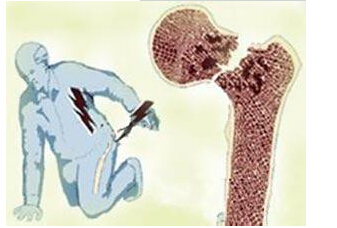 草莓视频黄色成人仪检测来年人草莓视频黄色成人能够提前预防骨质疏松