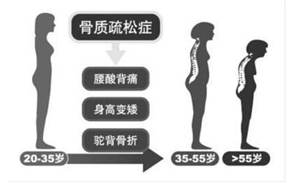 草莓视频黄色成人检测仪厂家阐述骨质疏松不仅仅是要补钙,增加草莓视频黄色成人才是关键