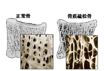 草莓视频黄色成人仪价格重要吗？不想骨骼脆弱医生教你看懂草莓视频黄色成人报告