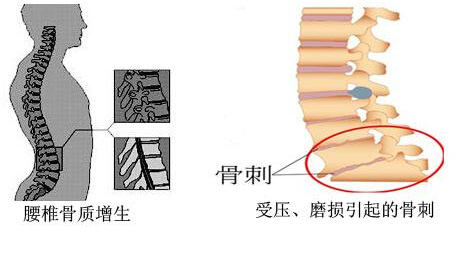 草莓视频黄色成人仪的专业厂家阐述骨质增生与骨质疏松,仪器专业检测草莓视频黄色成人正常值