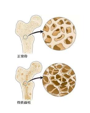 超声草莓视频黄色成人检测仪阐述爸妈变矮，催他们查草莓视频黄色成人预防骨质疏松