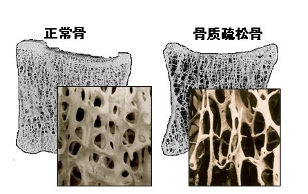 超声波草莓视频黄色成人仪阐述中老年不检测草莓视频黄色成人就像白蚁蛀房梁自行倒塌 超声波草莓视频黄色成人仪阐述中老年不检测草莓视频黄色成人就像白蚁蛀房梁自行倒塌