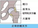 草莓视频黄色成人检查仪人身体出现哪些情况需要做髋关节置换术
