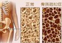 草莓视频黄色成人测试是通过草莓视频黄色成人检测仪器测试你是否患有骨质疏松症