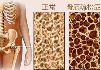 草莓视频黄色成人测试是通过草莓视频黄色成人检测仪器测试你是否患有骨质疏松症