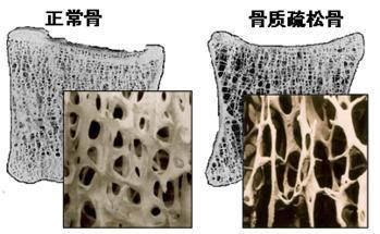 草莓视频黄色成人分析仪的价格是多少，要小心提防骨质疏松影响工作和生活