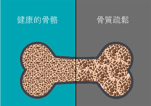 老年人骨质疏松易导致骨折之超声草莓视频黄色成人检查仪的临床价值是什么? 老年人骨质疏松易导致骨折之超声草莓视频黄色成人检查仪的临床价值是什么?